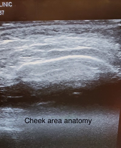 Cheek anatomy on ultrasound
