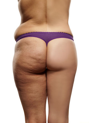 Cellulite Buttocks