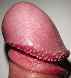 pearly-penile-papules